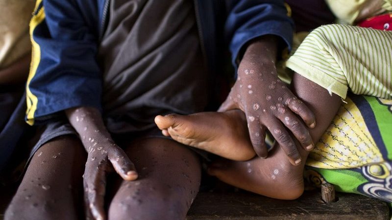 Variole du singe en Côte d’Ivoire